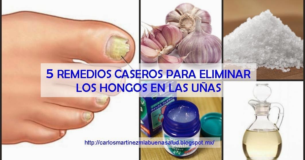 La desaparición del hongo de las uñas por el láser en kirove